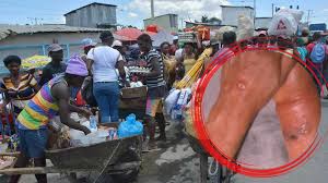 Haití confirma posibles casos de ántrax y activa medidas de emergencia en Petit-Goâve