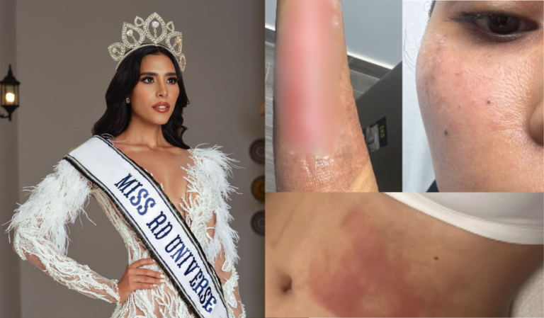 Debbie Aflalo, ex Miss República Dominicana 2021, sufre quemaduras tras explosión de olla de presión y advierte sobre su uso