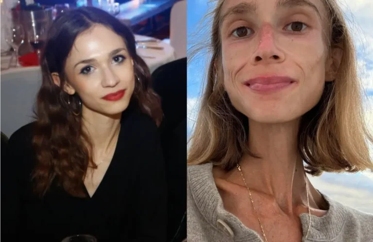 Murió Karolina Krzyzak por desnutrición tras dieta frutariana extrema